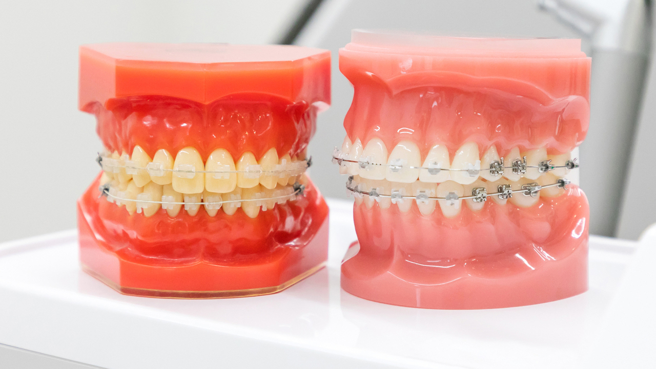 市原市・五井駅のワイヤー矯正