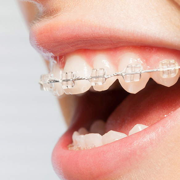 市原市・五井駅のワイヤー矯正