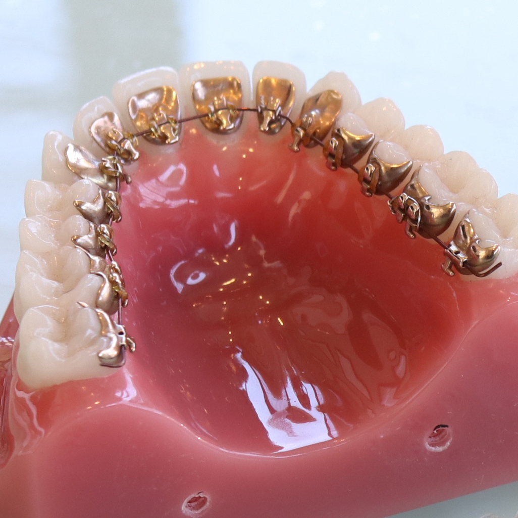 市原市・五井駅の舌側矯正